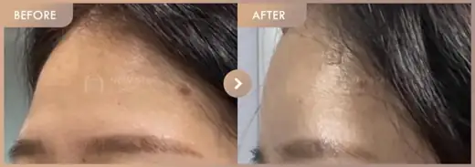 Forehead fillers: before-and-after comparison at Newstar Clinic