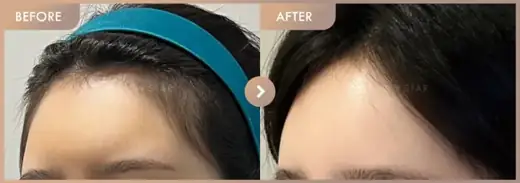 Forehead fillers: before-and-after comparison at Newstar Clinic