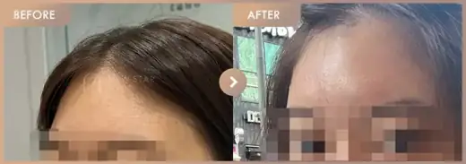 Forehead fillers: before-and-after comparison at Newstar Clinic