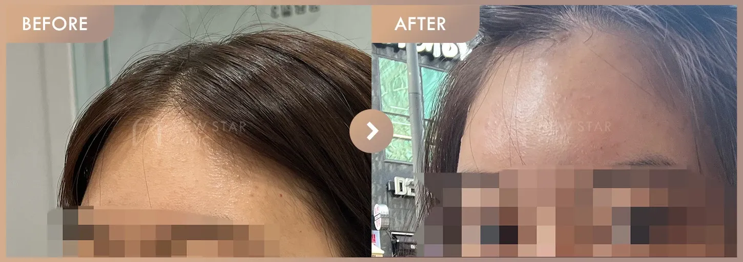 Forehead fillers before-and-after photos at Newstar Clinic