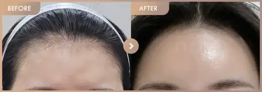 Forehead fillers: before-and-after comparison at Newstar Clinic