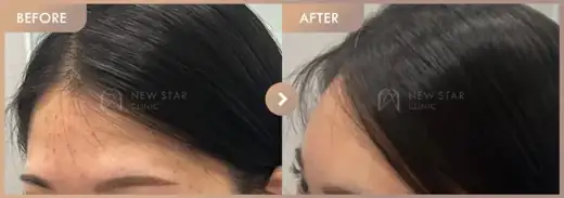 Forehead fillers: before-and-after comparison at Newstar Clinic