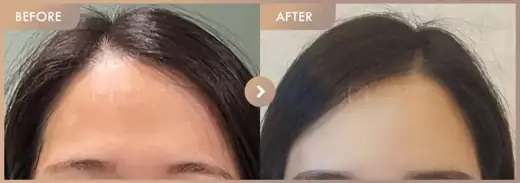 Forehead fillers: before-and-after comparison at Newstar Clinic