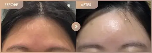 Forehead fillers: before-and-after comparison at Newstar Clinic