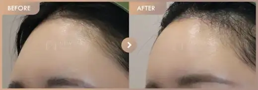 Forehead fillers: before-and-after comparison at Newstar Clinic