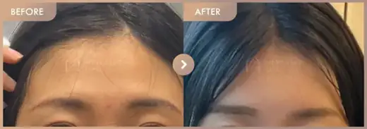 Forehead fillers: before-and-after comparison at Newstar Clinic