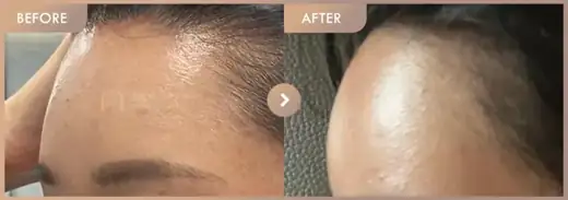 Forehead fillers: before-and-after comparison at Newstar Clinic