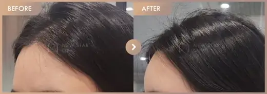 Forehead fillers: before-and-after comparison at Newstar Clinic