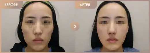 full-faceFiller: before-and-after comparison at Newstar Clinic