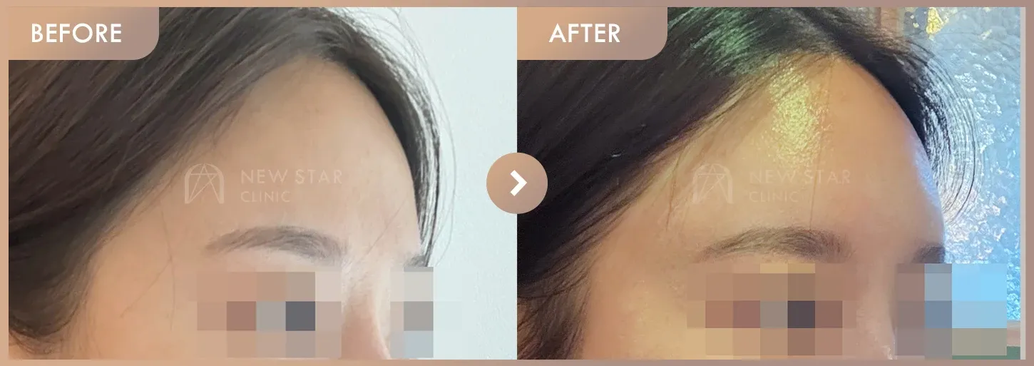 Forehead filler before-and-after photos at Newstar Clinic