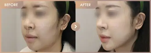 Forehead filler: before-and-after comparison at Newstar Clinic