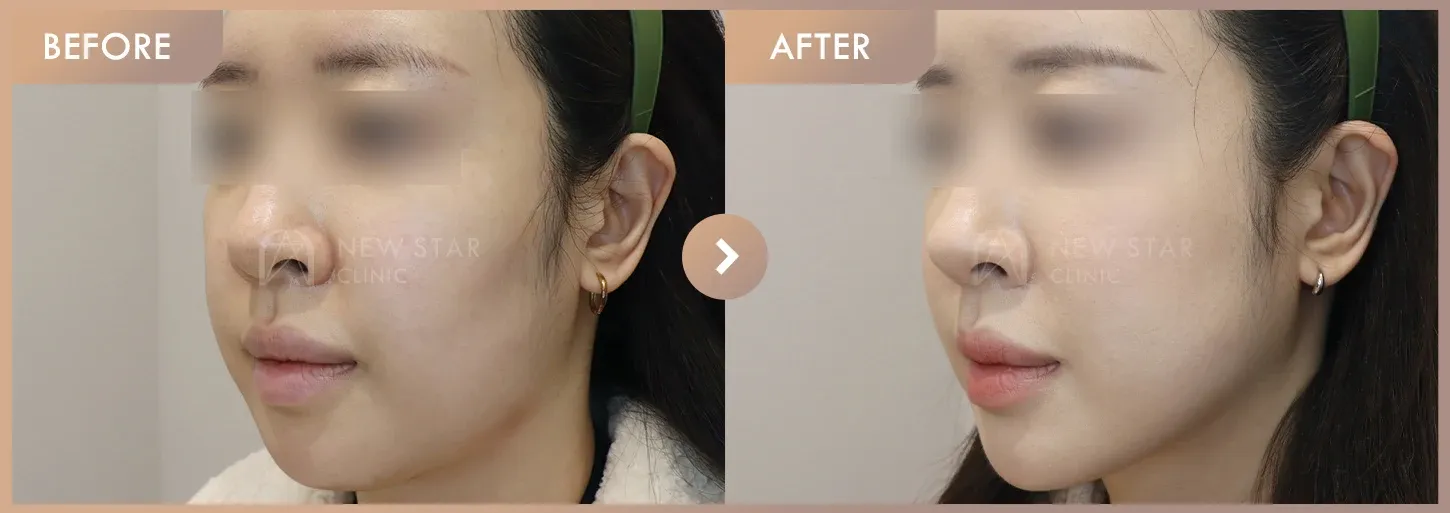 Forehead filler before-and-after photos at Newstar Clinic