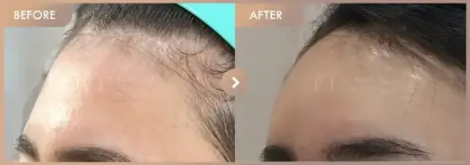 Forehead filler: before-and-after comparison at Newstar Clinic