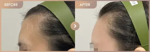 Forehead filler: before-and-after comparison at Newstar Clinic