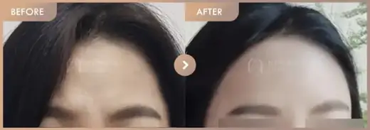 Forehead filler: before-and-after comparison at Newstar Clinic