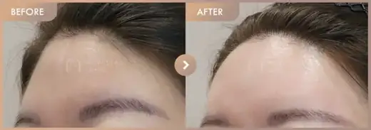 Forehead fillers: before-and-after comparison at Newstar Clinic