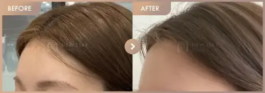 Forehead fillers: before-and-after comparison at Newstar Clinic