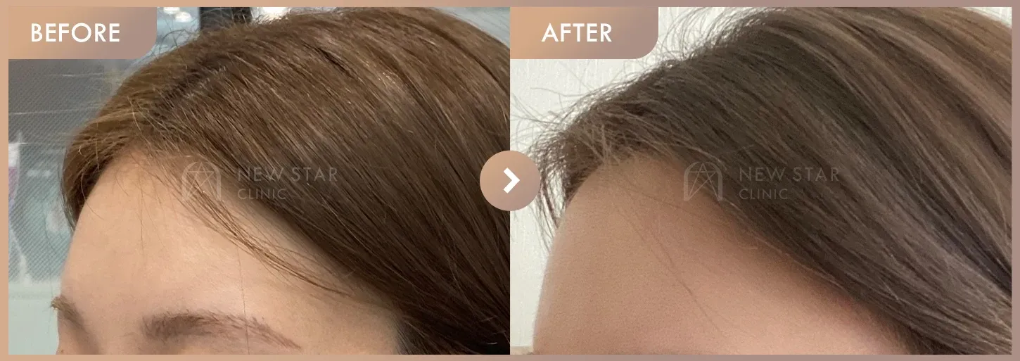 Forehead fillers before-and-after photos at Newstar Clinic