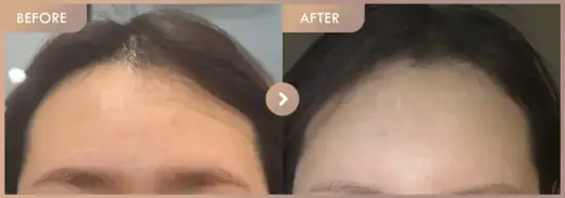 Forehead fillers: before-and-after comparison at Newstar Clinic