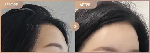 Forehead fillers: before-and-after comparison at Newstar Clinic