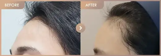 Forehead fillers: before-and-after comparison at Newstar Clinic