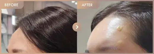 Forehead fillers: before-and-after comparison at Newstar Clinic