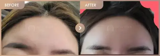 Forehead fillers: before-and-after comparison at Newstar Clinic