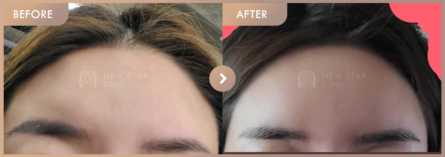 Forehead fillers before-and-after photos at Newstar Clinic