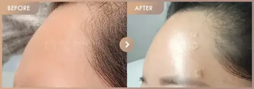 Forehead fillers: before-and-after comparison at Newstar Clinic