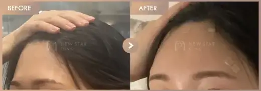 3099-4e31-9a2b-6f0adb13c537: before-and-after comparison at Newstar Clinic