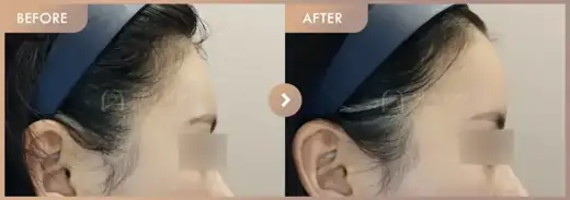 Forehead fillers: before-and-after comparison at Newstar Clinic