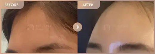 Forehead fillers: before-and-after comparison at Newstar Clinic