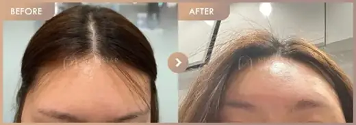Forehead fillers: before-and-after comparison at Newstar Clinic