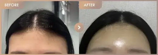 Forehead fillers: before-and-after comparison at Newstar Clinic
