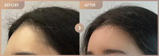 Forehead fillers: before-and-after comparison at Newstar Clinic