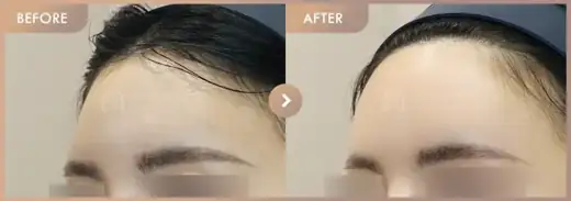 Forehead fillers: before-and-after comparison at Newstar Clinic