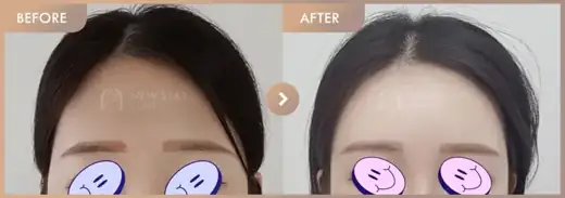 Forehead fillers: before-and-after comparison at Newstar Clinic