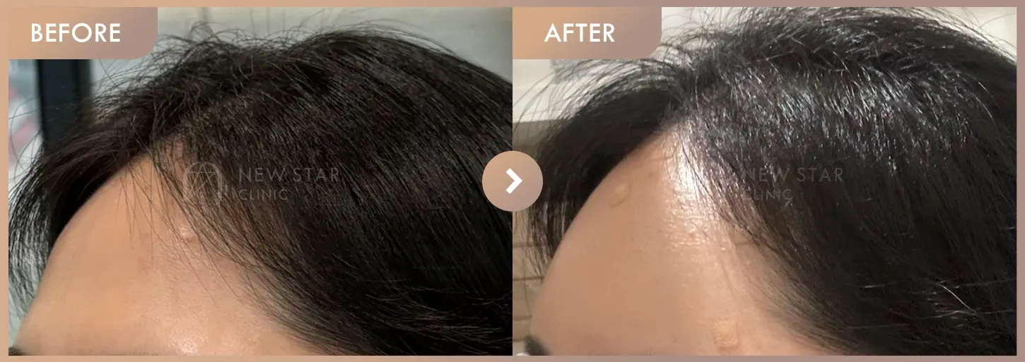 Forehead fillers before-and-after photos at Newstar Clinic