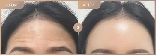Forehead fillers: before-and-after comparison at Newstar Clinic