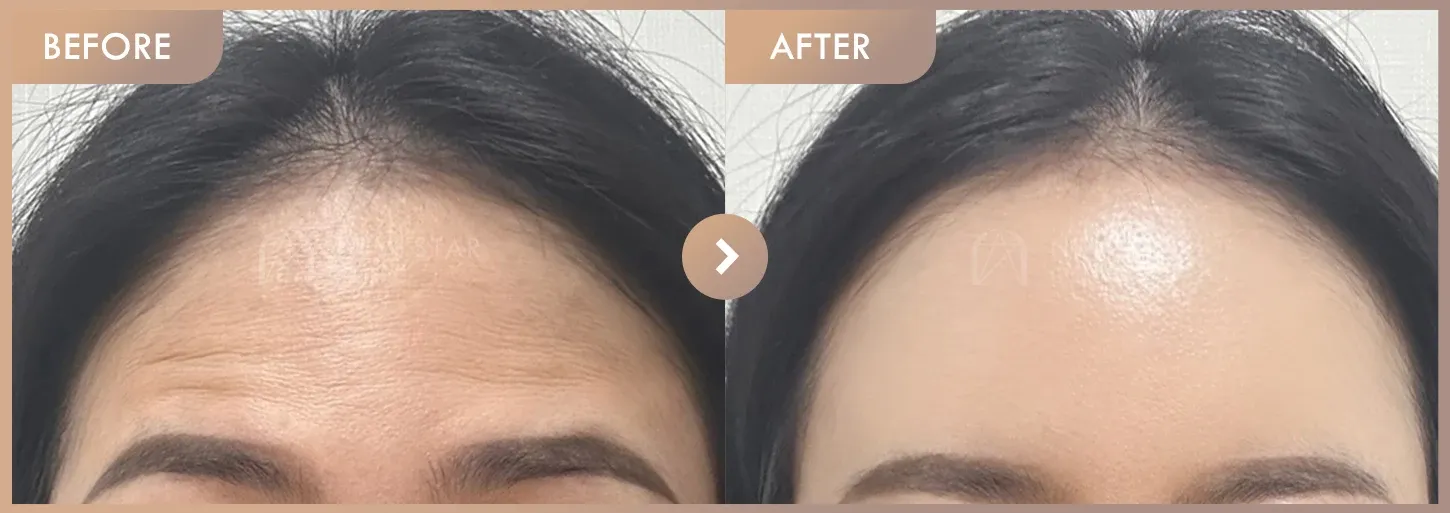 Forehead fillers before-and-after photos at Newstar Clinic