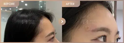Forehead fillers: before-and-after comparison at Newstar Clinic