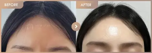 Forehead fillers: before-and-after comparison at Newstar Clinic