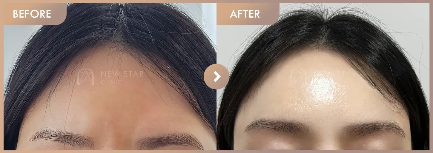 Forehead fillers before-and-after photos at Newstar Clinic