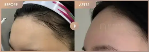 Forehead fillers: before-and-after comparison at Newstar Clinic