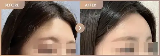 Forehead fillers: before-and-after comparison at Newstar Clinic