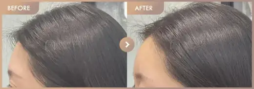 Forehead fillers: before-and-after comparison at Newstar Clinic