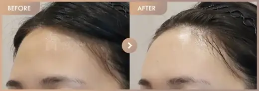 Forehead fillers: before-and-after comparison at Newstar Clinic