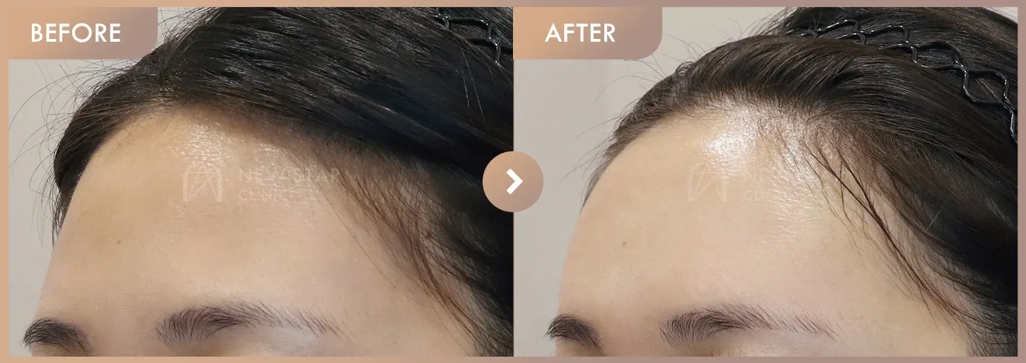 Forehead fillers before-and-after photos at Newstar Clinic