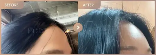 Forehead fillers: before-and-after comparison at Newstar Clinic