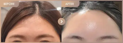 Forehead fillers: before-and-after comparison at Newstar Clinic